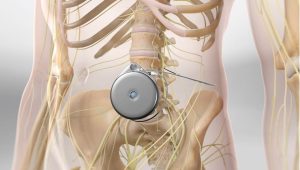 spolnost baklofenska črpalka