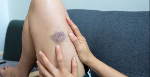 Modrice, krvavitve, bolečine v sklepih: Kdaj je čas, da obiščete zdravnika?