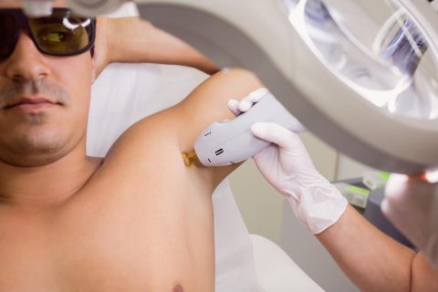 laserska epilacija za moške