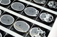Preboj v medicini? Umetna inteligenca odkriva nekaj, kar bi lahko rešilo življenja