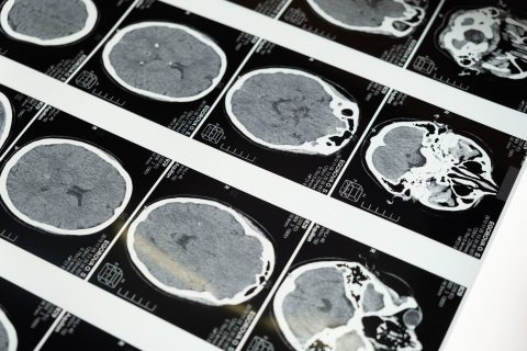 Preboj v medicini? Umetna inteligenca odkriva nekaj, kar bi lahko rešilo življenja