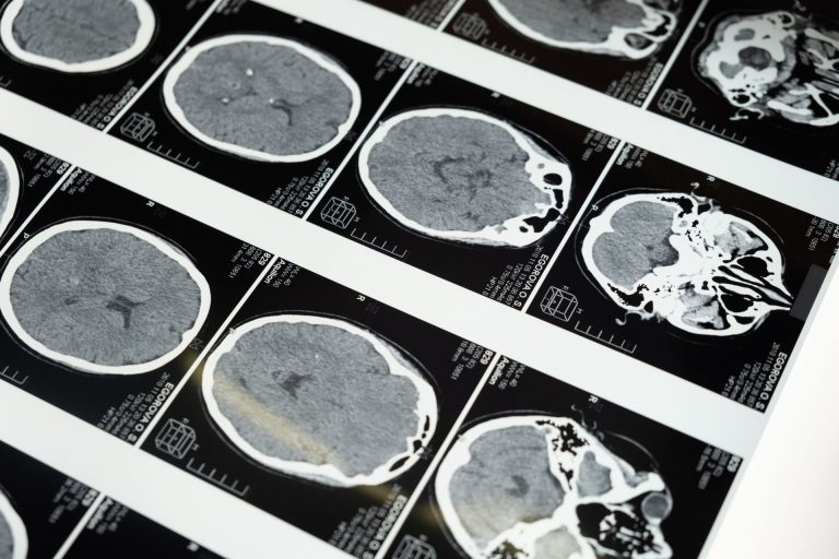 Preboj v medicini? Umetna inteligenca odkriva nekaj, kar bi lahko rešilo življenja